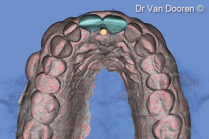 7. Superimposing the STL file and the Dicom files in the planning software (MSoft/MIS) allowed us to plan the exact position of the new implant