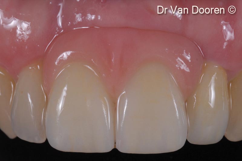 18. Final clinical result. Note the integration and gingival health
