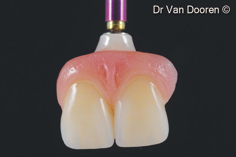 17. A 2-unit screw retained zirconia bridge (#11 and #21) and a single crown (tooth #22) were milled and layered