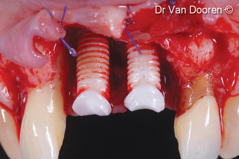8.  Considerable bone loss around the existing implants and mesially to the lateral incisors: the two implants were removed