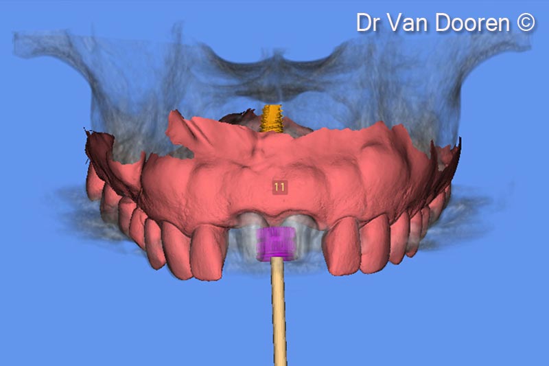 5. Superimposing the STL file and the Dicom files in the planning software (MSoft/MIS) allowed us to plan the exact position of the new implant