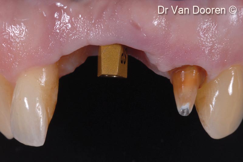 16. Occlusal view after 4 months. Please note the excellent soft tissue health and three-dimensional stability of the residual ridge after grafting