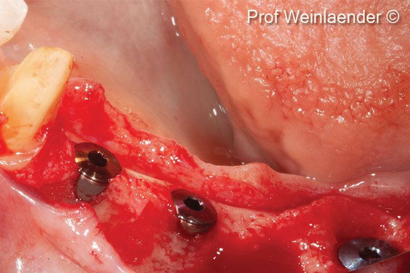 1. Positioning of 3 implants position #44 #45 #46. #44 and #45 situated in a narrow ridge #46 immediate implantation - Lateral view