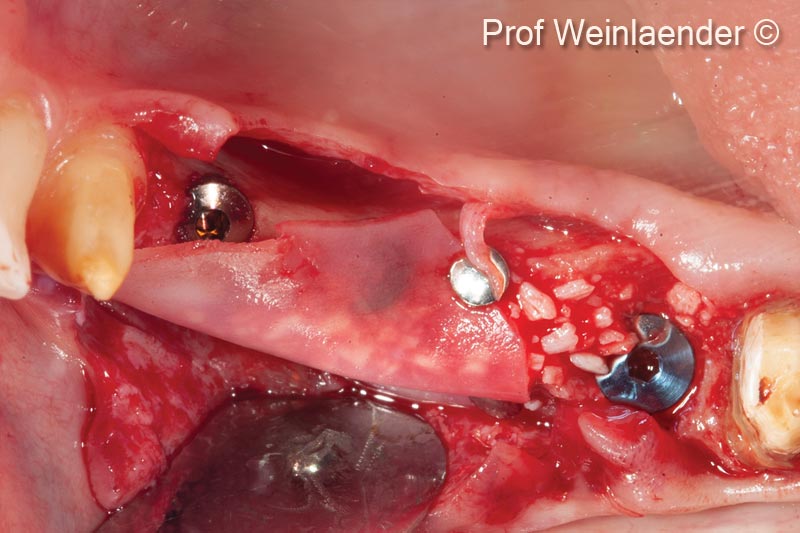 3. Placement of the bone Lamina with the creation of a stable lateral void through pin fixation at the height of tooth 43, the depth of the vestibulum, the occlusal part of the alveolar ridge and the filling of the created void with the use of mp3® (xenogenic prehydrated collagenated cortico-cancellous bone particles