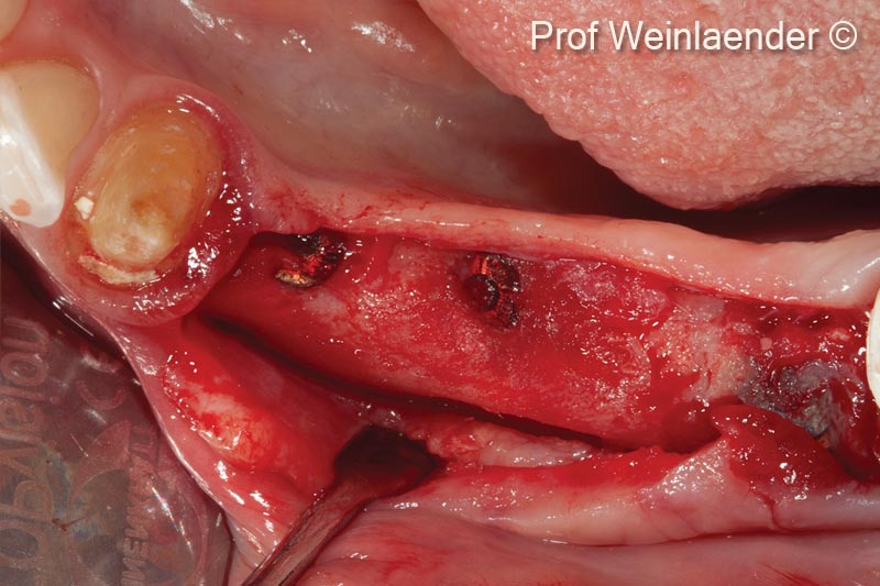 4. Situation 8 months postoperative. Transformation of the GBR complex into a clinically successful augmentation not only covering the exposed coronal parts of implants but also extending the lateral aspect of the alveolar ridge for about 3-4 mm additionally