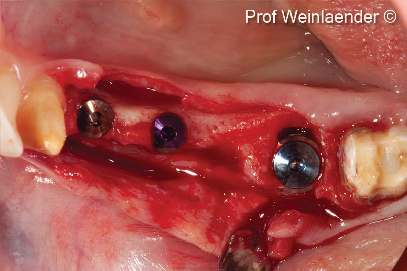 2. Positioning of 3 implants position #44 #45 #46. #44 and #45 situated in a narrow ridge #46 immediate implantation - Occlusal view