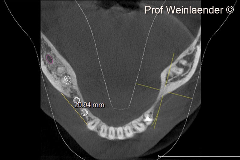 5.  Occlusal DVT view of implants in position #44 #45 #46 with the desired augmentative planning indicated by a straight line