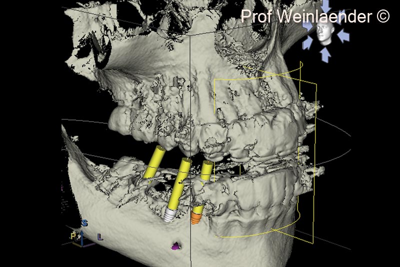 9. 3D Surface rendering DVT. Demonstration of narrow ridge with exposed implants in positions #44 and #45