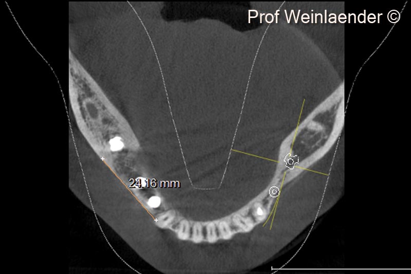 6.  Occlusal DVT view of implants in position #44 #45 #46 with the obtained augmentation indicated by a straight line