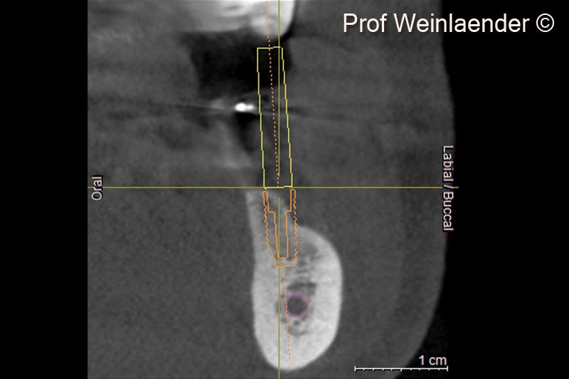 8.  Radial DVT view implant position #45 indicating the amount of alveolar ridge resorption at the planned implant position