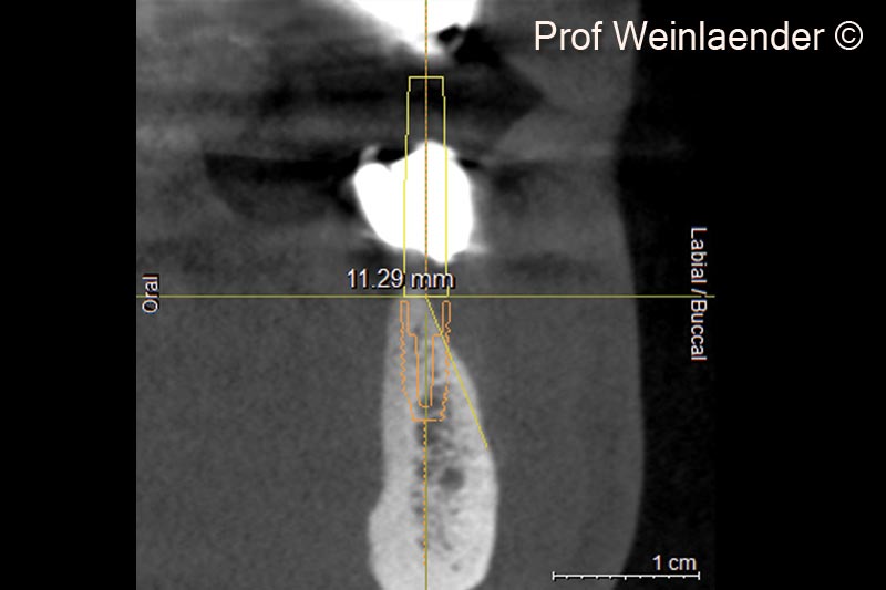 7.  Radial DVT view implant position 44 indicating the amount of alveolar ridge resorption at the planned implant position
