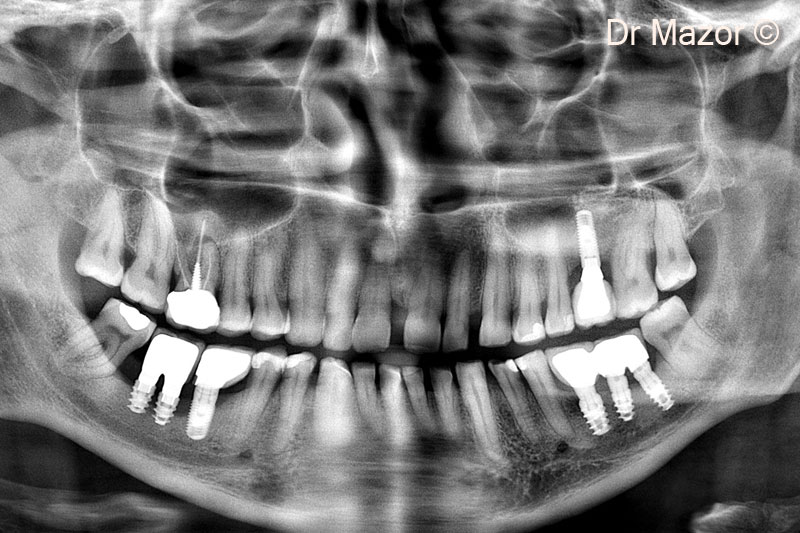 1. Pre-operative panoramic view