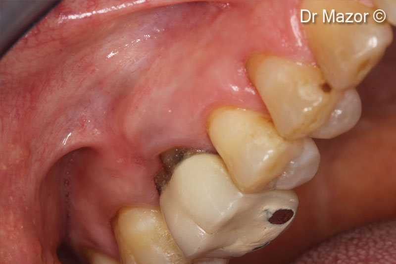 2. Clinical view of tooth #16