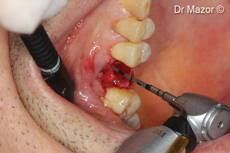 5. 1.6mm pointed drill marking osteotomy site in the furcation area