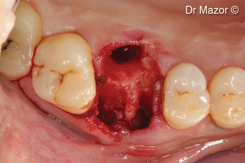 4. Occlusal view of the extraction socket