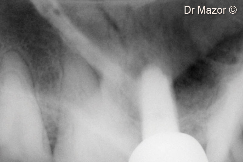 16. 2 years post-op periapical X-ray