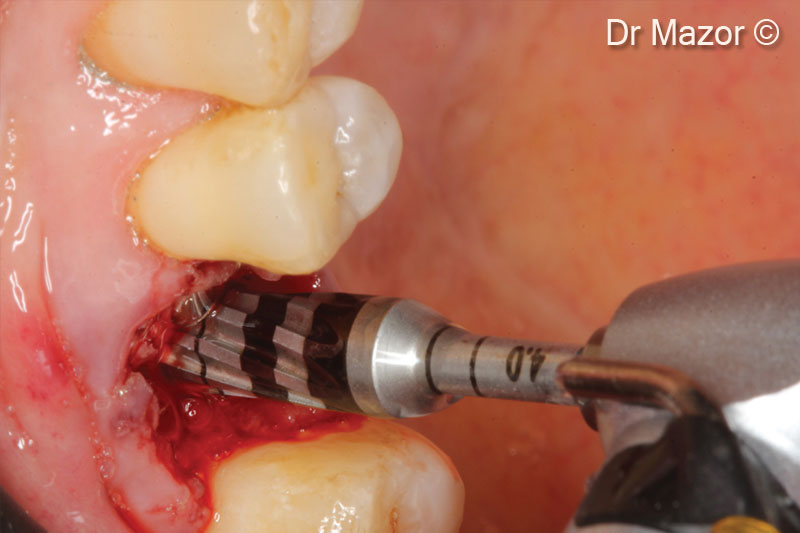 11. Elevating the Putty using 4mm diameter Versah drill