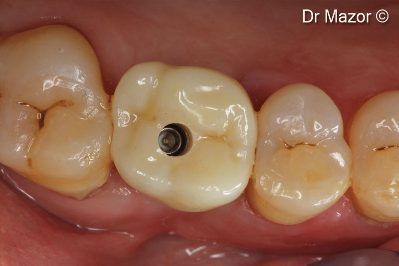 15. Screw retained zirconia crown in place