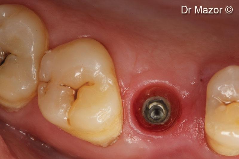 13. Soft tissue healing around the healing abutment