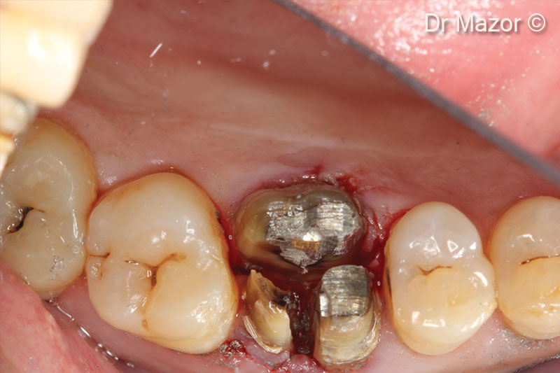 3. Root separation ensuring atraumatic extraction