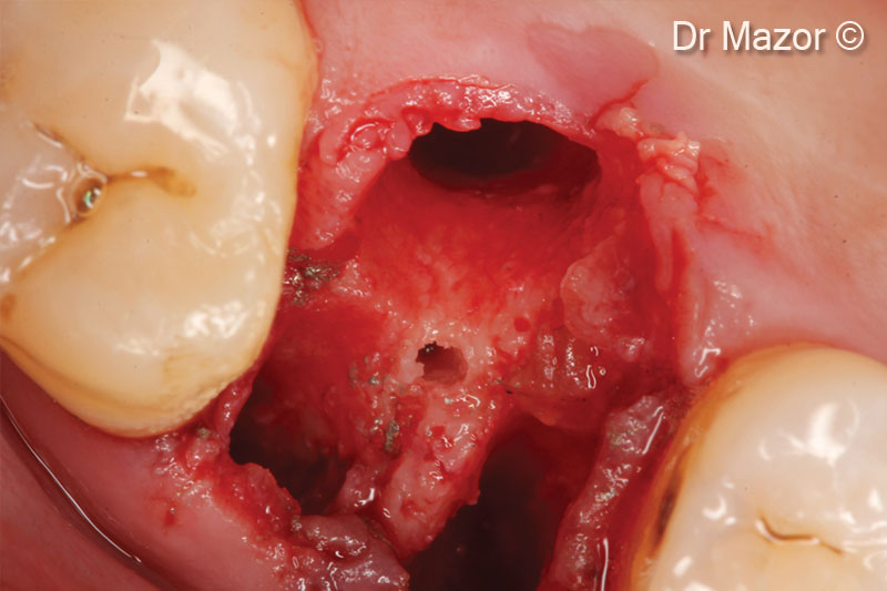 6. Occlusal view after site is marked