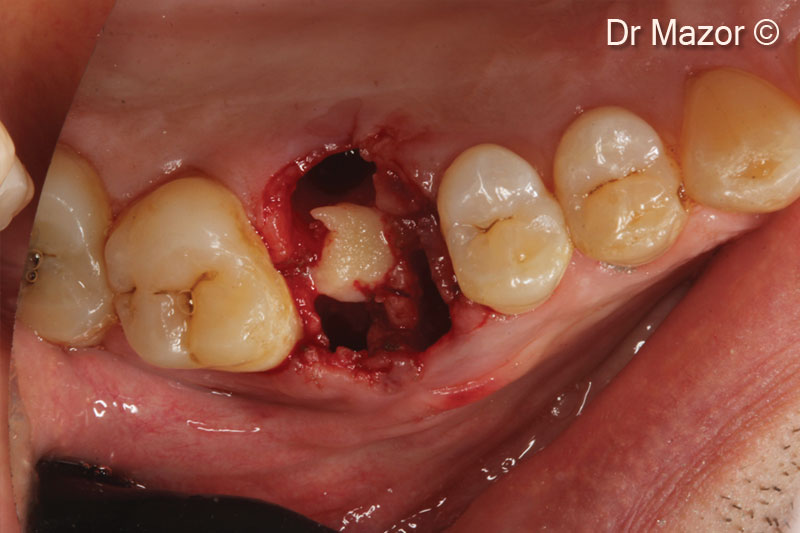 Subcrestal minimal invasive sinus...