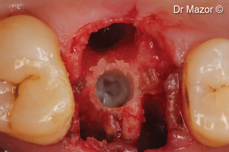 9. Osteotomy expansion with subcrestal elevation using 3mm Densah drill