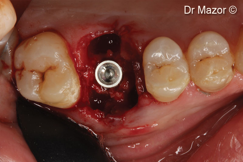 12. Implant insertion