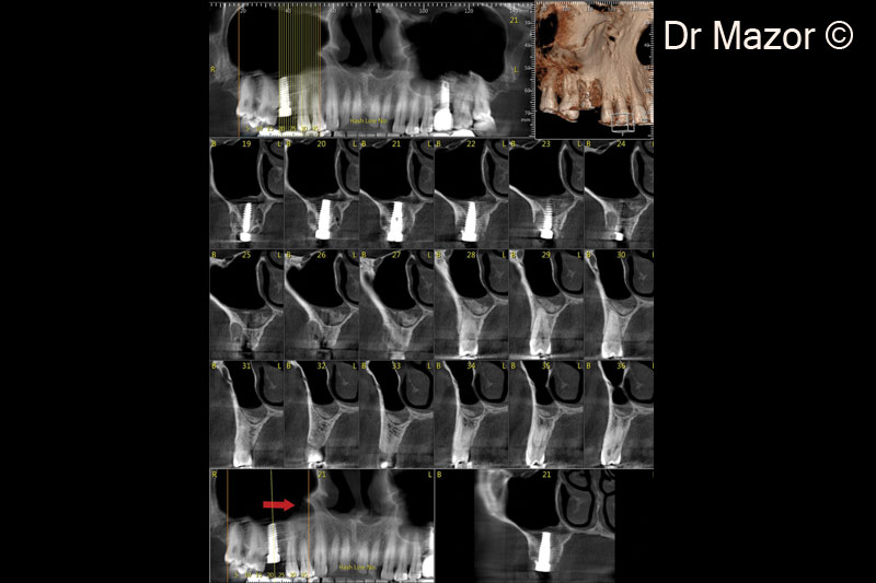 14. Post-op CBCT verifying bone consolidation around the implant