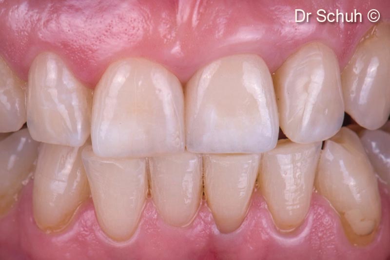 2. Final treatment result after extraction of tooth #21, implantation, immediate restoration and site development according to the multilayertechnique (MLT) and new full ceramic crown #21