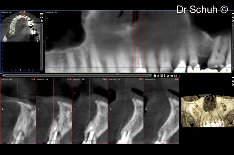 3. CBCT scan before treatment. #21 presenting an apical lesion and the missing buccal bony plate