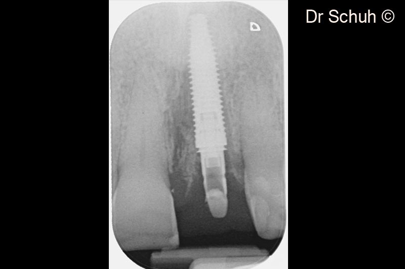 5.  X-ray #21 after implantation according to MLT and immediate restoration with a screw retained provisional