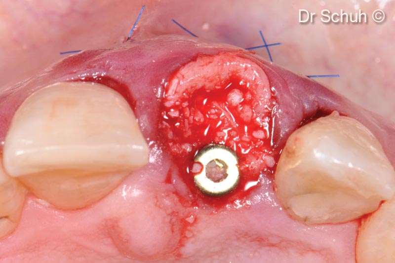4. Immediate implant placement and reconstruction of the missing buccal bony plate with a soft bone lamina and CT graft. The gap is filled with particulate bone substitute (mp3<sup>®</sup>)