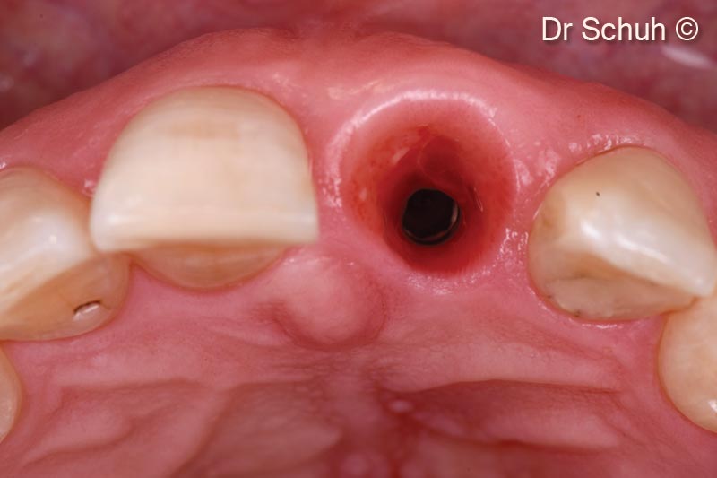 6. Occlusal view after 3 months immediately before final restoration