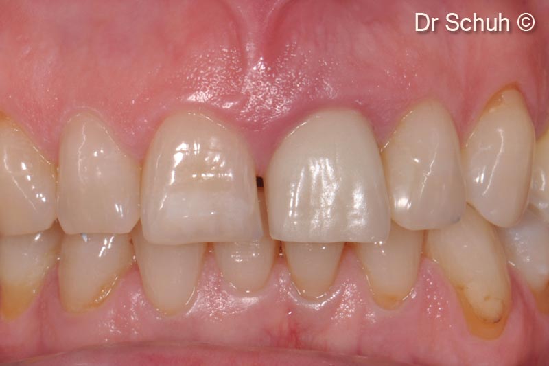 1. Patient received a crown on a endodontic treated tooth #21. Tooth #21 is failing, presenting a fistula and a root fracture
