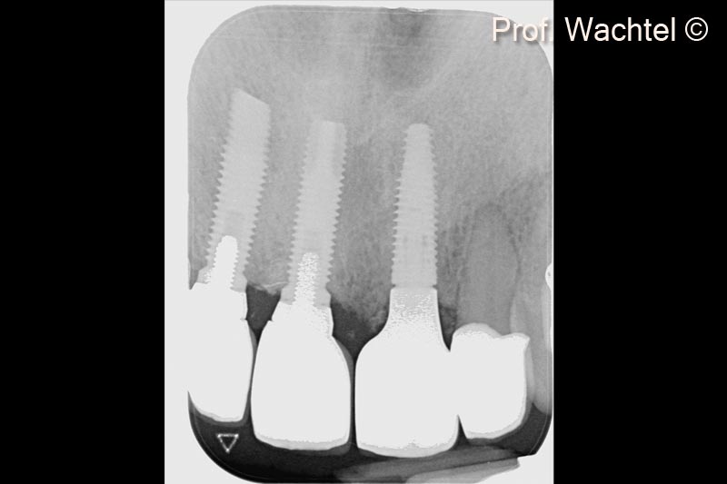4. X-ray of the 3 implants: #12 and #11 18 years old - #21 implantation according to MLT