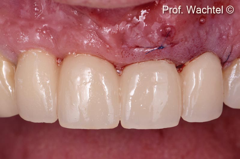 6. Frontal view immediately after surgery and inserting the temporary bridge