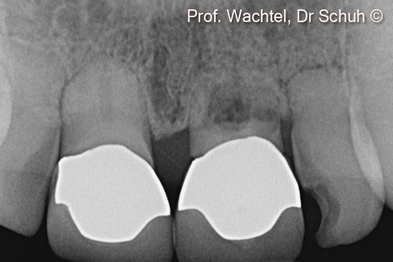 3.  X-Ray before treatment displays extended root resorption of all front teeth