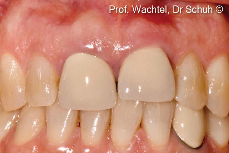 1. Patient received a longlasting orthodontic treatment resulting in vertical gingival and incisal discrepancy and increased tooth mobility of #12, #11, #21 and #22 caused by excessive root resorption