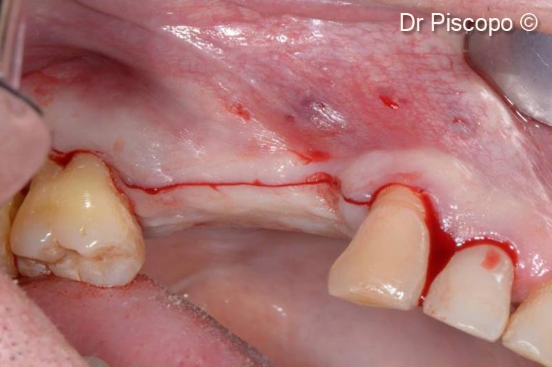 3. Vestibular supracrestal incision in order to ensure the amount of mucous tissue sufficient to cover the graft