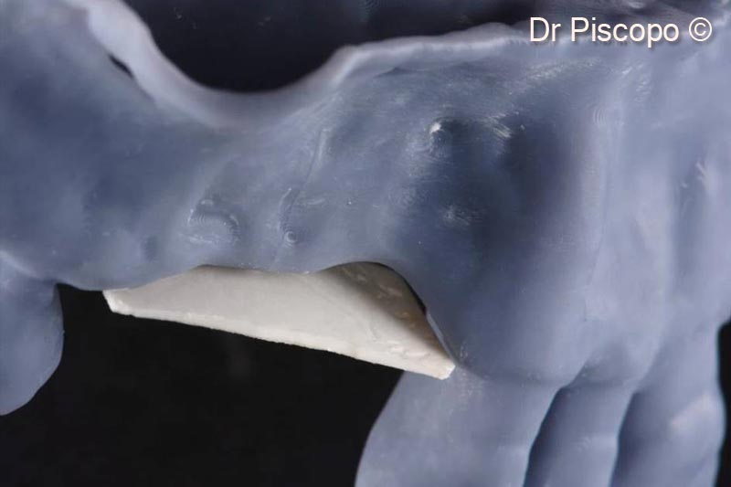 1. Oblique cranial view of the horizontal atrophic defect on a stereolithographic model
