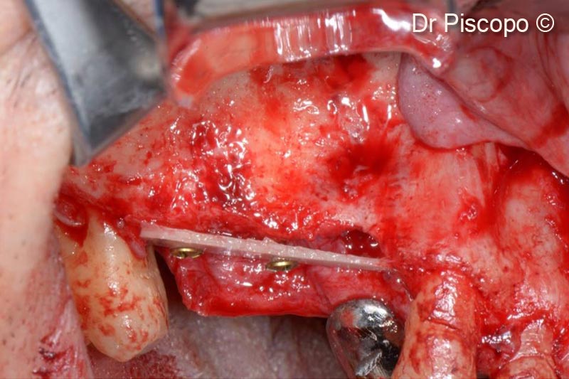 5. 1 mm thick OsteoBiol® Rigid Lamina positioned on the crestal side, to delimit the vertical atrophic defect, fixed with 1.3 mm osteosynthesis screws