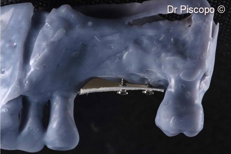 2. Lateral palatal view of the vertical atrophic defect on a stereolithographic model