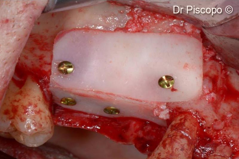 Horizontal and Vertical atrophic defect...