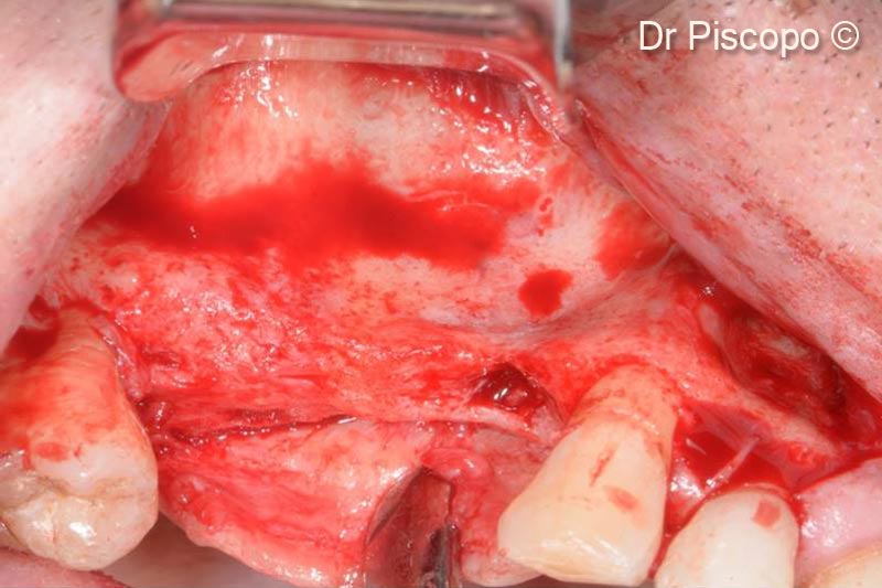 4. Preparation of the recipient site by means of a full-thickness trapezoidal flap