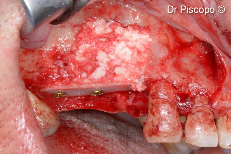 6. Atrophic defect filled with 50% GTO® OsteoBiol® and 50% autologous bone