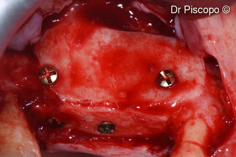 8.  Second access performed 8 months after surgery