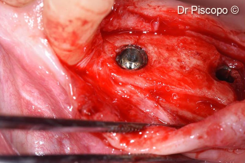 11. Surgical re-entry 4 months after implant positioning