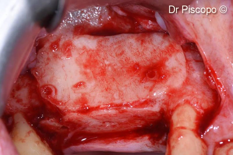 9. Removal of the osteosynthesis screws