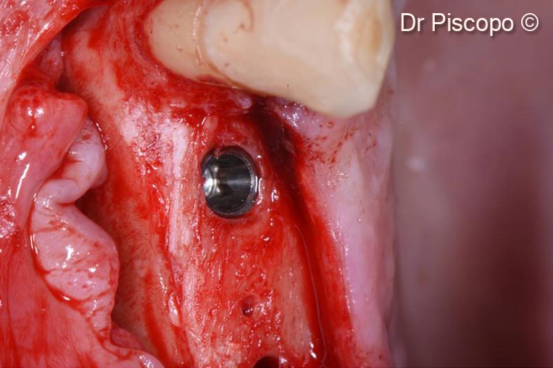 10. Insertion of 2 implant fixtures with 4x12mm and 4x10mm diameter